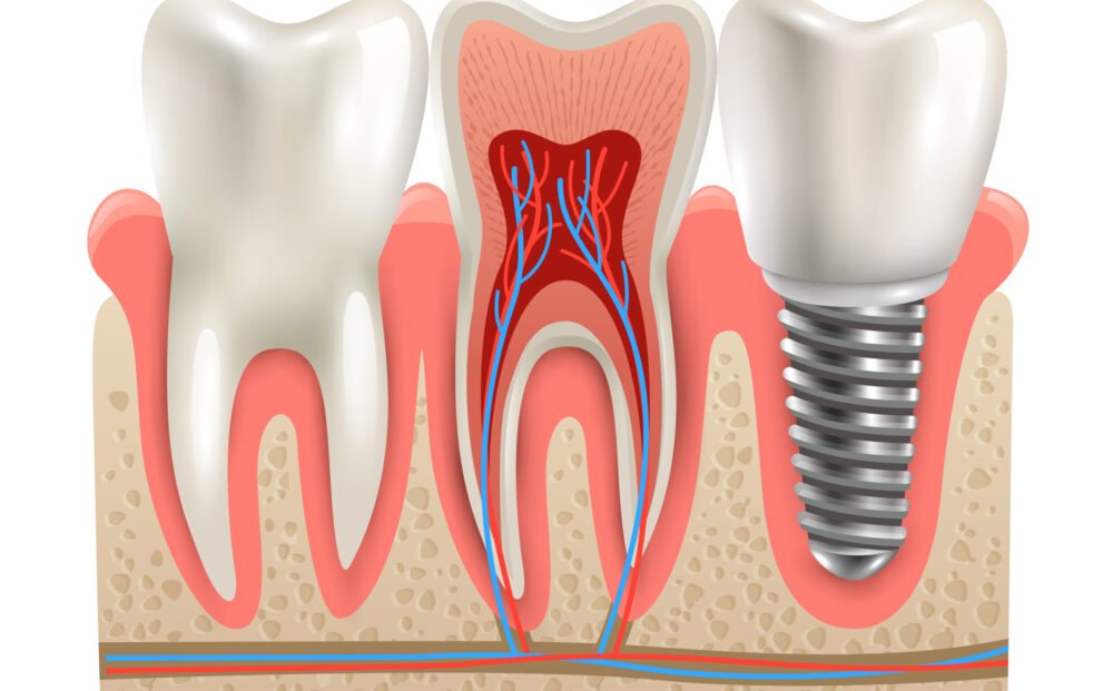 Dental implant and real tooth anatomy closeup cut away section model side view realistic vector illustration