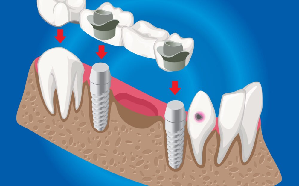 Isometric prosthetic dentistry concept with dental bridge used for missing teeth covering isolated vector illustration SSUCv3H4sIAAAAAAACA02RT0/DMAzFv0rkc2Egbr1P/JEQExwnDm5iWm9pMiVuxzT1u+N0rcQttp/es3+5QoOZLdRXYO+HLAmFY4D6sQJyLDExeqgfpgqyoAyZsmq1sijU6nSuV5P9tfShhhdCL53FRJt3tbHqoQZDo6OP5kBWMkzVKl47q+I1R6/uDqbvCrClYC8lU0MTecJ5hb2Ojmeh1C/7jOwo3p44OC5PGKMG6/yp7Ku3xb5024Snjm3ikVKpHWWbbrE9SWJrTilm6Uj06SgIK5WLsTFYOok5s3RzG71pEruWjFJx5icm03POHFojRCqyURNKyctBZtQ7Vfaf9L3ZKmZsPJnt7stgcOaTgiNVBfO2ey6+vWKqQH4LLKgWajevvFn2GtBvupn6XV+IcyCVxqP+5DRNfzV3PGTnAQAA